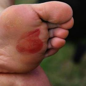 ampolla_fascitis_plantar